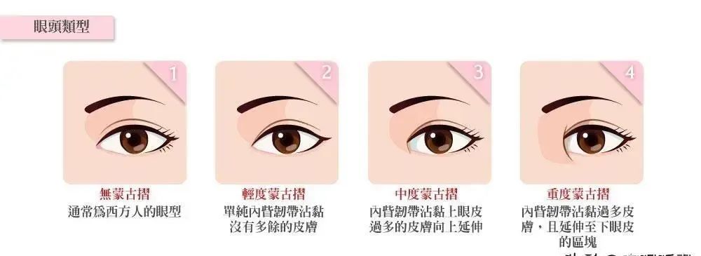 单双眼皮